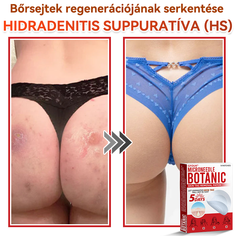 👩🏻‍⚕️GFOUK® ✅Mikrotűs növényi bőrkinövés eltávolító tapasz