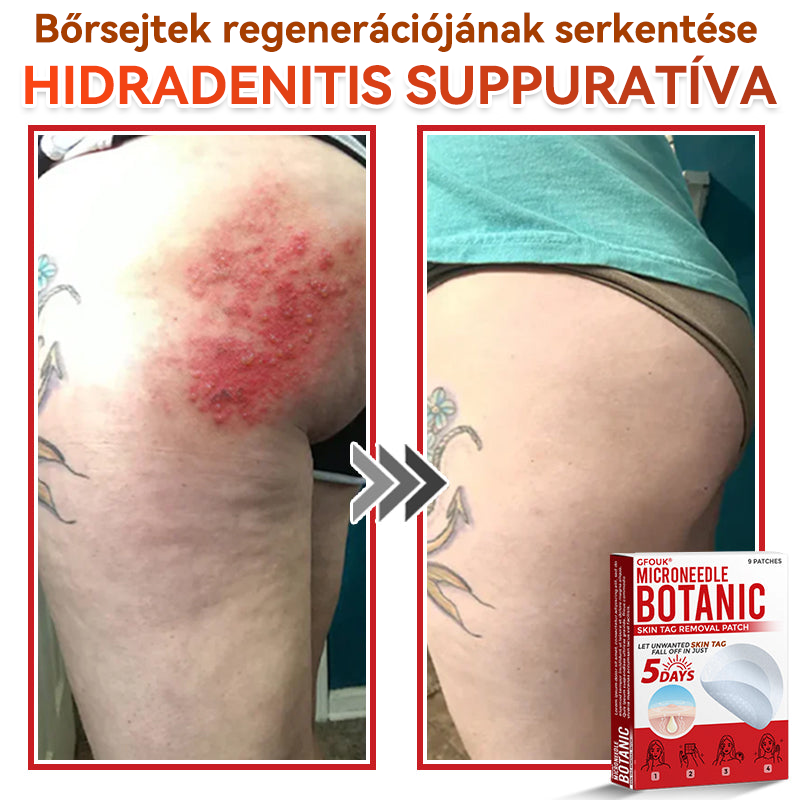 👩🏻‍⚕️GFOUK® ✅Mikrotűs növényi bőrkinövés eltávolító tapasz
