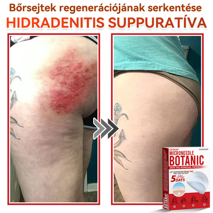 👩🏻‍⚕️GFOUK® ✅Mikrotűs növényi bőrkinövés eltávolító tapasz