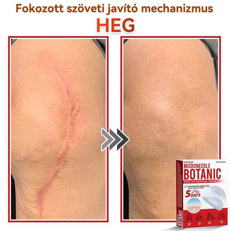 👩🏻‍⚕️GFOUK® ✅Mikrotűs növényi bőrkinövés eltávolító tapasz