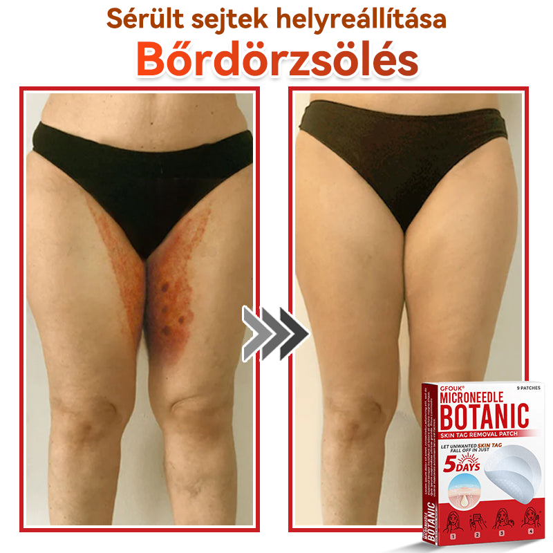👩🏻‍⚕️GFOUK® ✅Mikrotűs növényi bőrkinövés eltávolító tapasz