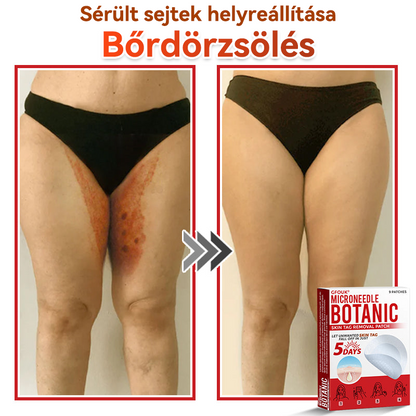 👩🏻‍⚕️GFOUK® ✅Mikrotűs növényi bőrkinövés eltávolító tapasz