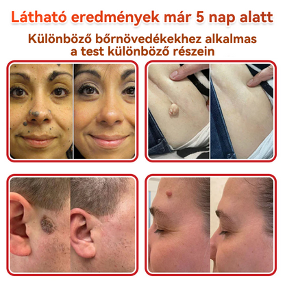 👩🏻‍⚕️GFOUK® ✅Mikrotűs növényi bőrkinövés eltávolító tapasz