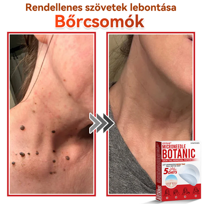 👩🏻‍⚕️GFOUK® ✅Mikrotűs növényi bőrkinövés eltávolító tapasz