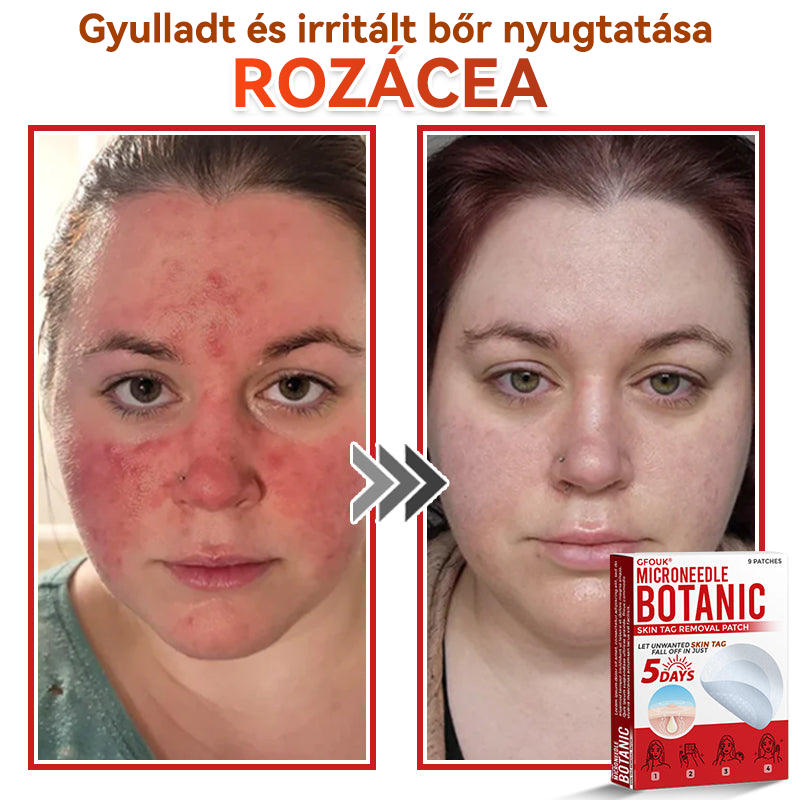 👩🏻‍⚕️GFOUK® ✅Mikrotűs növényi bőrkinövés eltávolító tapasz