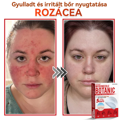 👩🏻‍⚕️GFOUK® ✅Mikrotűs növényi bőrkinövés eltávolító tapasz