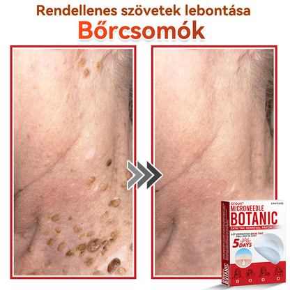 👩🏻‍⚕️GFOUK® ✅Mikrotűs növényi bőrkinövés eltávolító tapasz