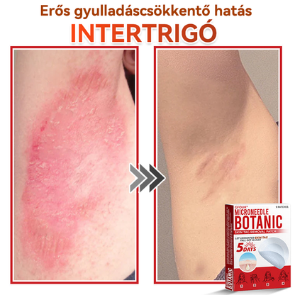 👩🏻‍⚕️GFOUK® ✅Mikrotűs növényi bőrkinövés eltávolító tapasz